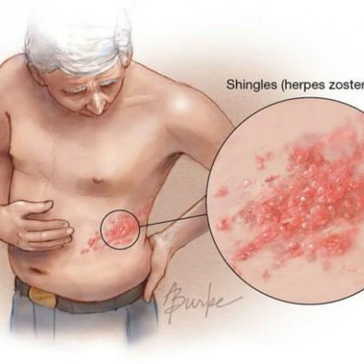 Shingles 01