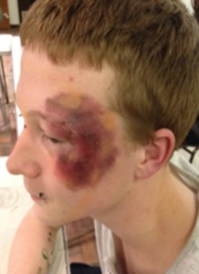 bruised actor
