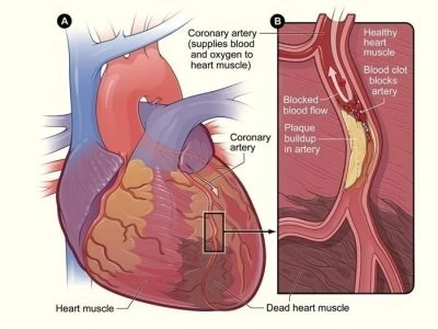 cardiovasculardisease 01
